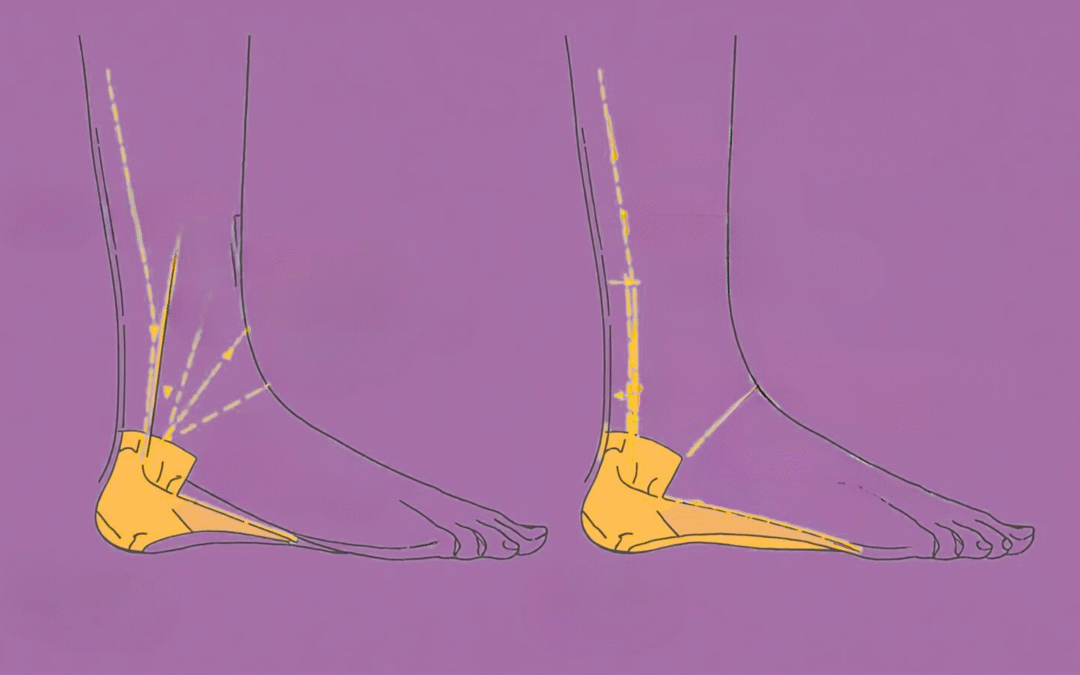 Why Foot Arch Collapse Can Lead to More Than Just Foot Pain