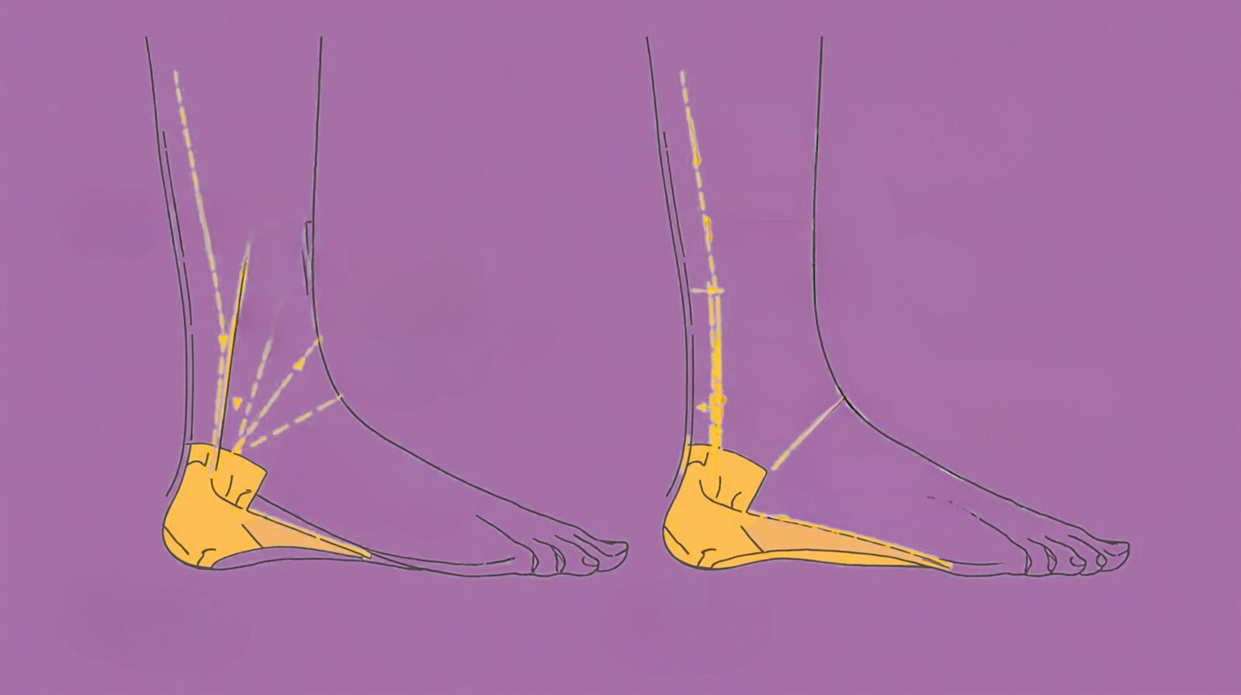 Foot Arch Collapse Illustration of collapsed foot arch causing imbalance and body pain