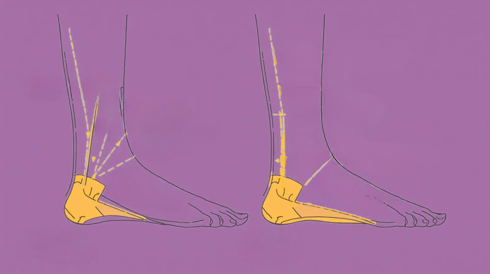 Illustration of collapsed foot arch causing imbalance and body pain