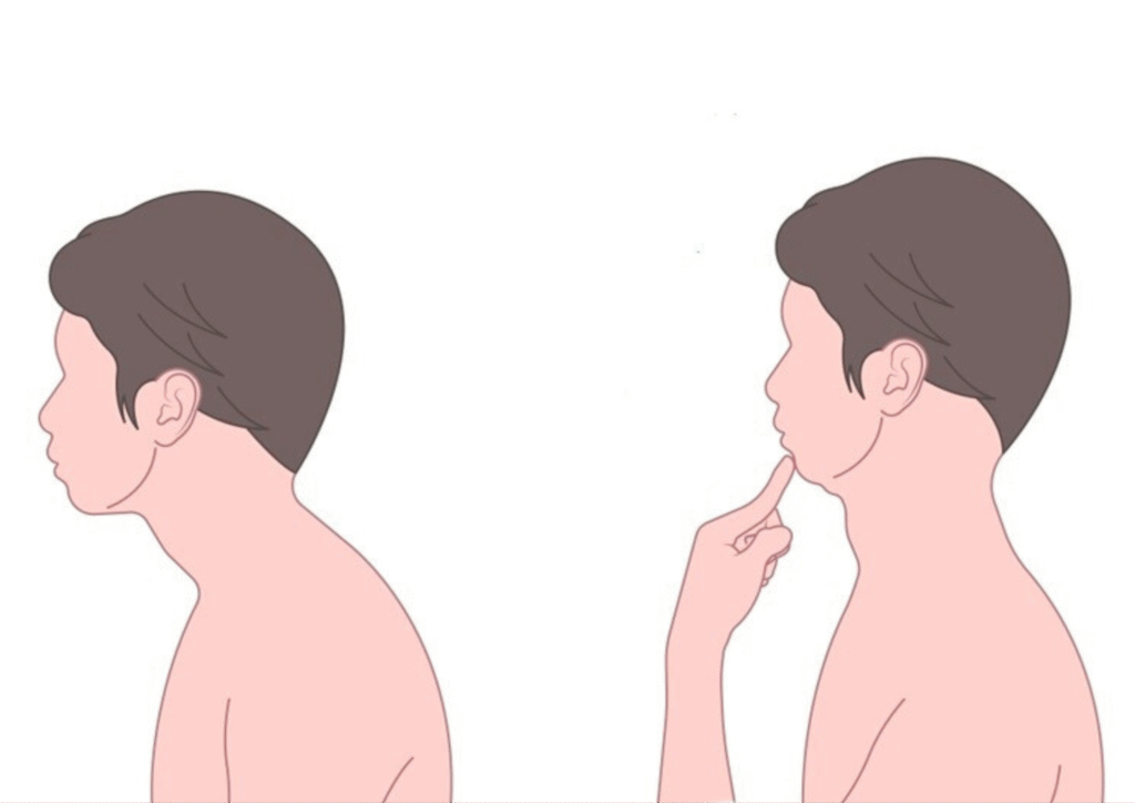 Chin Tucks:- for Tech Neck