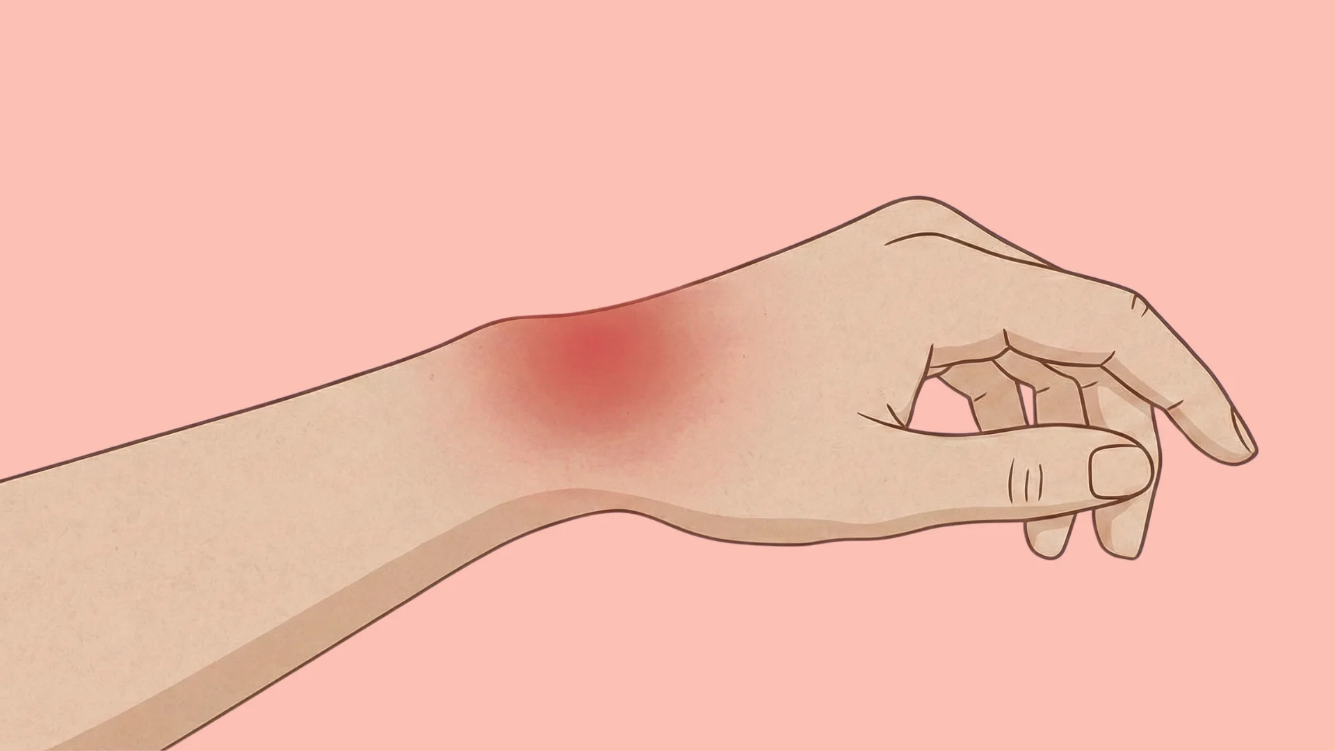 Dorsal wrist pain Dorsal wrist pain