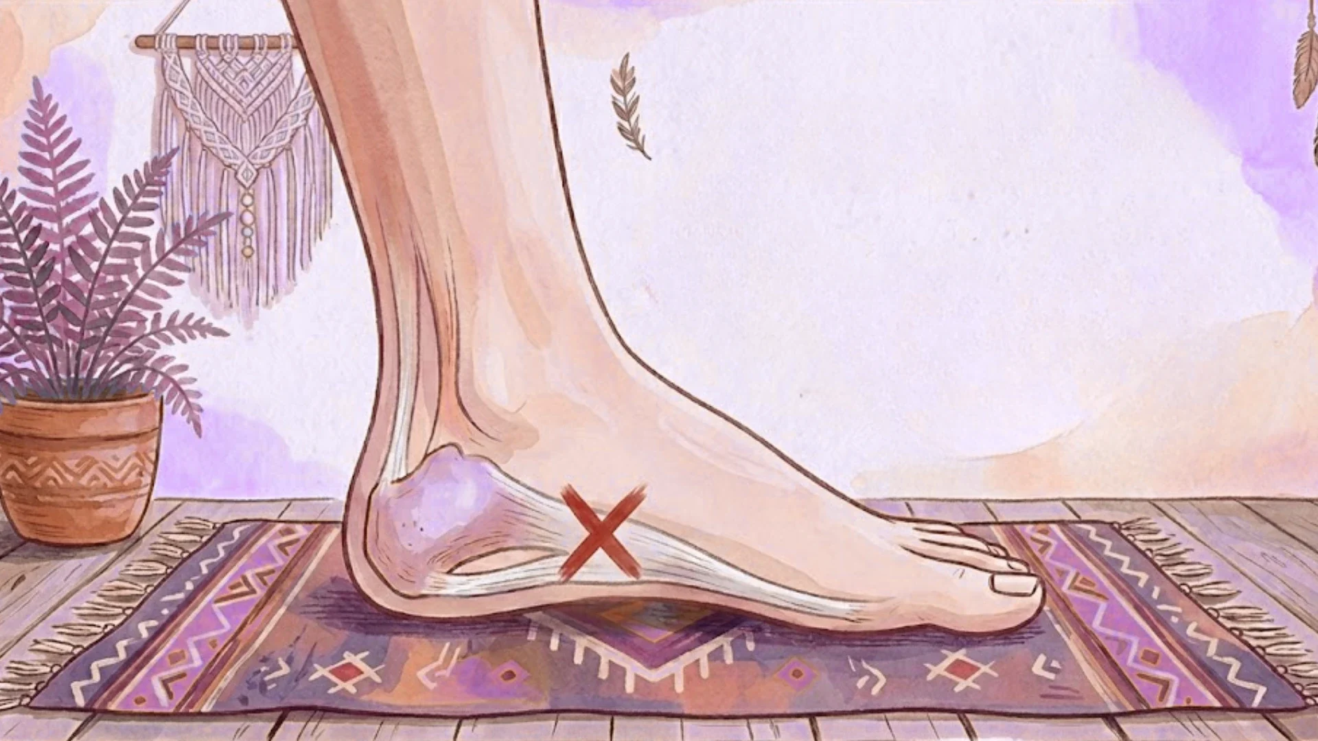 Plantar Fasciitis